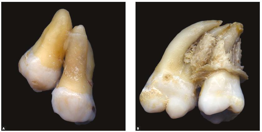 Concrescence: can the teeth involved be moved or separated?