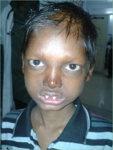 photo of a boy with ectodermal dysplasia
