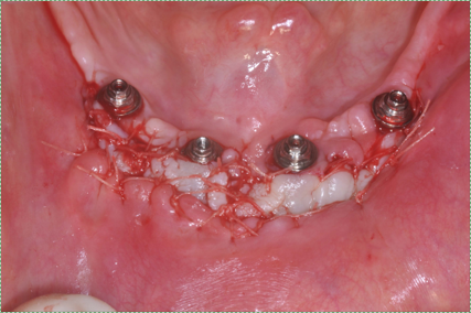 medical photo of a free gingival graft